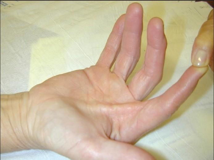 bowstring_phenomenon_clinical_example14D6983353C2EA96A07 Extreme IT